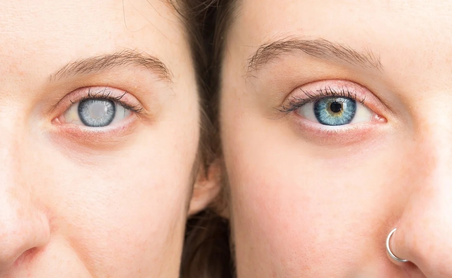 Avances en el tratamiento del glaucoma